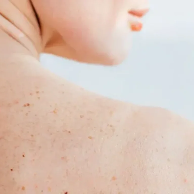 Pigmentation-600x400